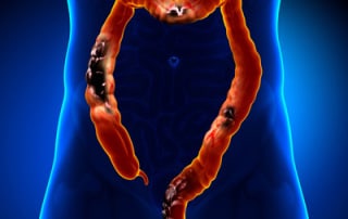 colon cancer illustration on male anatomy