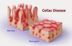 celiac disease damages the small intestine