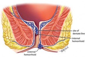 hemorrhoid image illustrating internal and external hemorrhoids