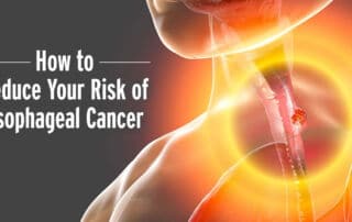 esophageal cancer: learn how to reduce your risk