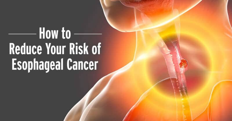 Esophageal Cancer: Reduce Your Risk | Russell Havranek, MD