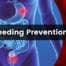 GI bleeding prevention tips