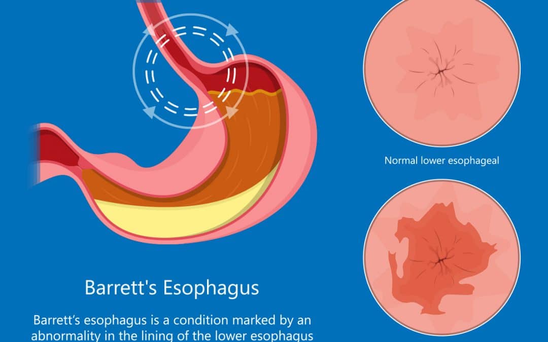 barrett's esophagus compared to a normal lower esophageal